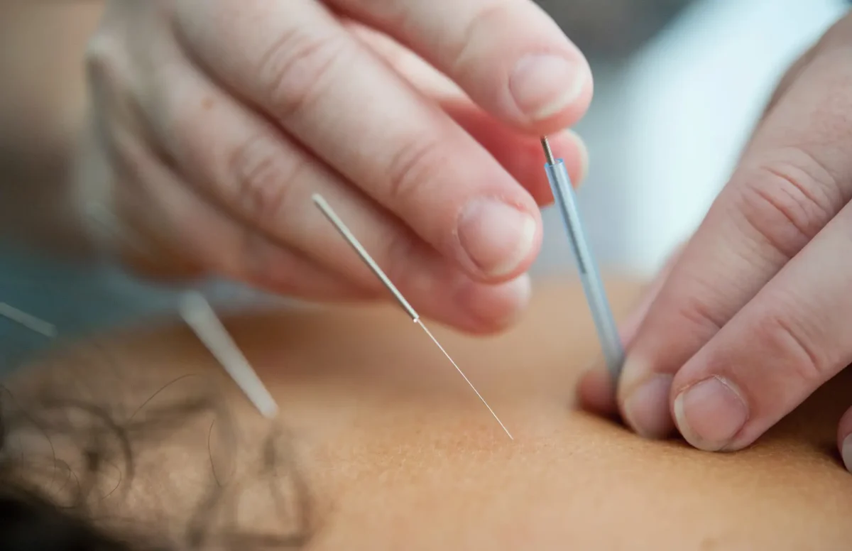 acupuncture therapy langford