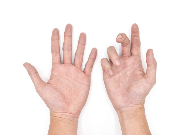 ulnar claw hand of asian young man. also known as 'spinster's claw.